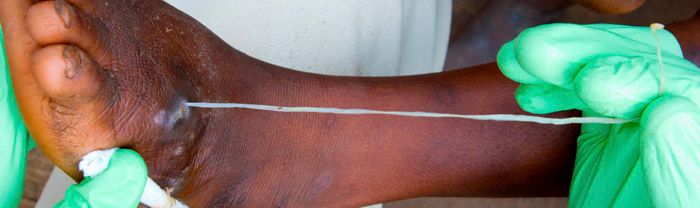 guinea worm parasite