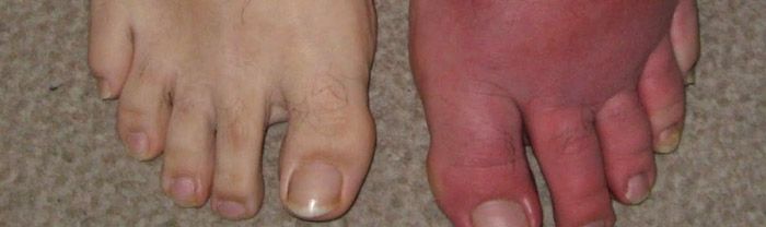 Cellulitis infection